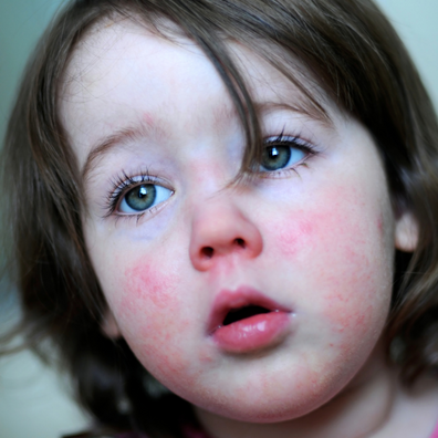 Strep A & Scarlet Fever - Self Care Forum